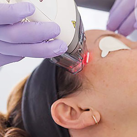 Treat Hyperpigmentation with our Fraxel® at SF Bay Cosmetic Surgery Medical Group in San Ramon