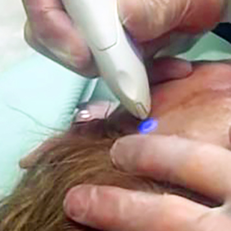 Treat wrinkles with our JPlasma Portrait at SF Bay Cosmetic Surgery Medical Group in San Ramon