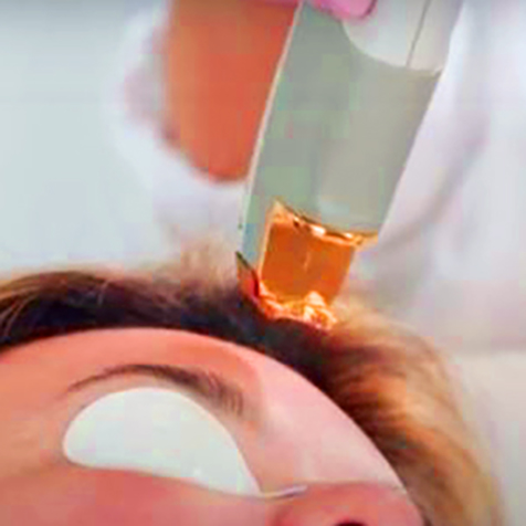 Treat Wrinkles with our LaserGenesis® at SF Bay Cosmetic Surgery Medical Group in San Ramon