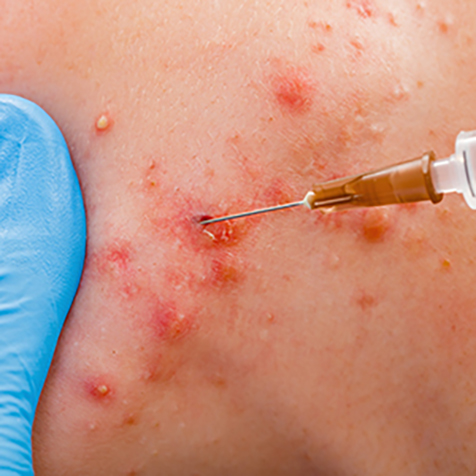 Treat Acne & Acne Scars with our Subcision at SF Bay Cosmetic Surgery Medical Group in San Ramon