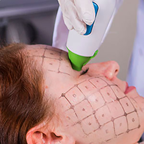 Treat Wrinkles with our Thermage® Face at SF Bay Cosmetic Surgery Medical Group in San Ramon
