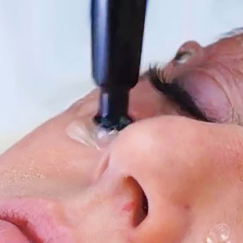 Treat Wrinkles with our ThermiSmooth® Face at SF Bay Cosmetic Surgery Medical Group in San Ramon