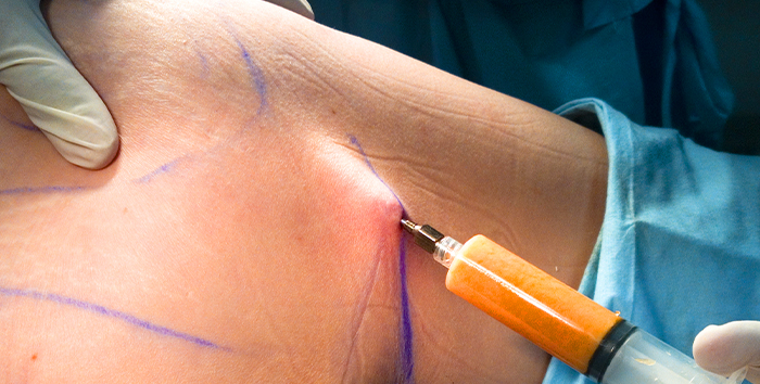 Surgeon performing a fat transfer procedure marked on a patient's body in an operating room