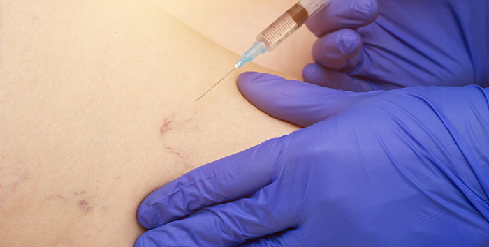 Provider injecting a sclerotherapy solution into a spider vein on a patient's leg