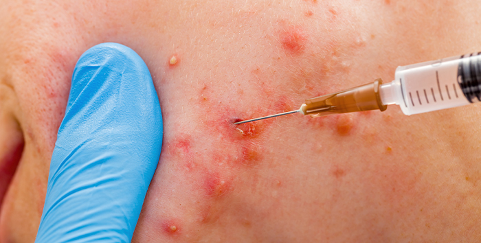 Provider performing a subcision procedure on a patient's acne-scarred skin